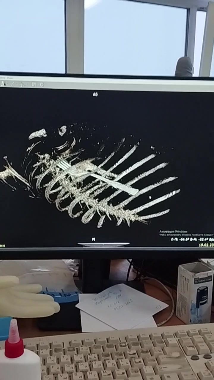 В Беларуси женщина случайно проглотила вилку 7 Миниатюра видео